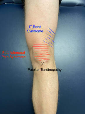 knee-injury-location-pain